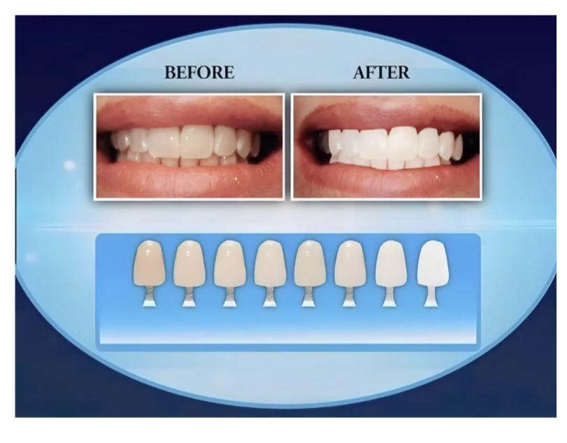 ACABA CON EL AMARILLO DE TUS DIENTES EN 3 PASOS CON NUESTRO UV